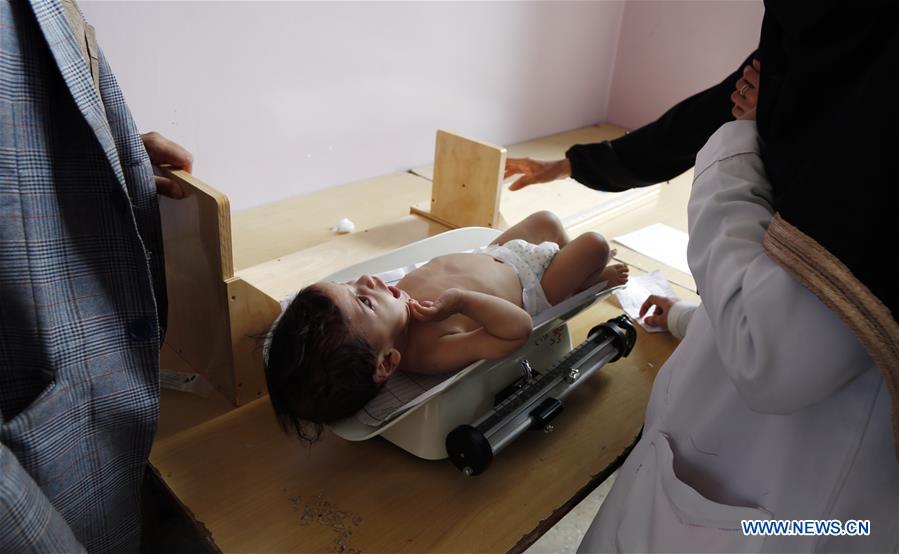 YEMEN-SANAA-CHILDREN-MALNUTRITION