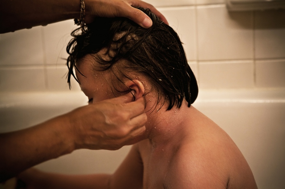 孤兒?。呼~鱗病女孩的艱難生活【圖】